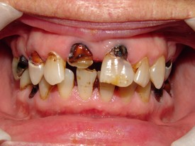 Dentures - BEFORE