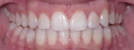 Invisalign - AFTER