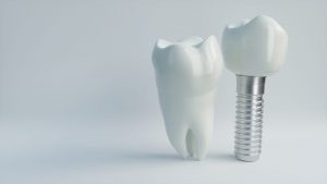 A featured website image for dental implants in trenton featuring an example of a dental implant