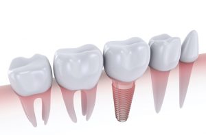 a picture of dental implants in Trenton