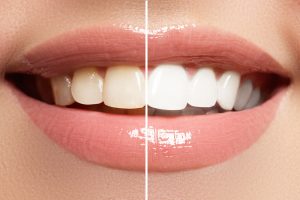teeth whitening cost in canada featured image