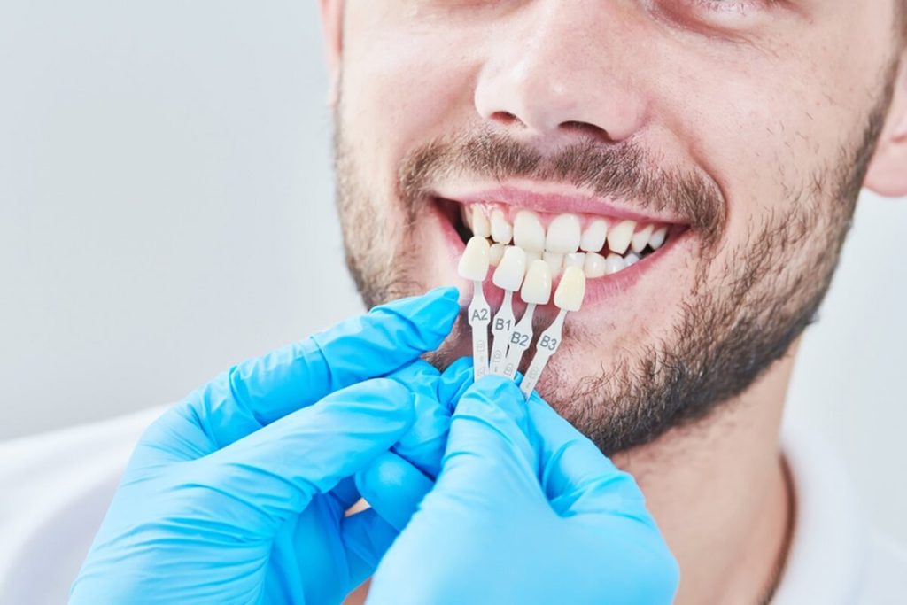 applying veneer to man teeth