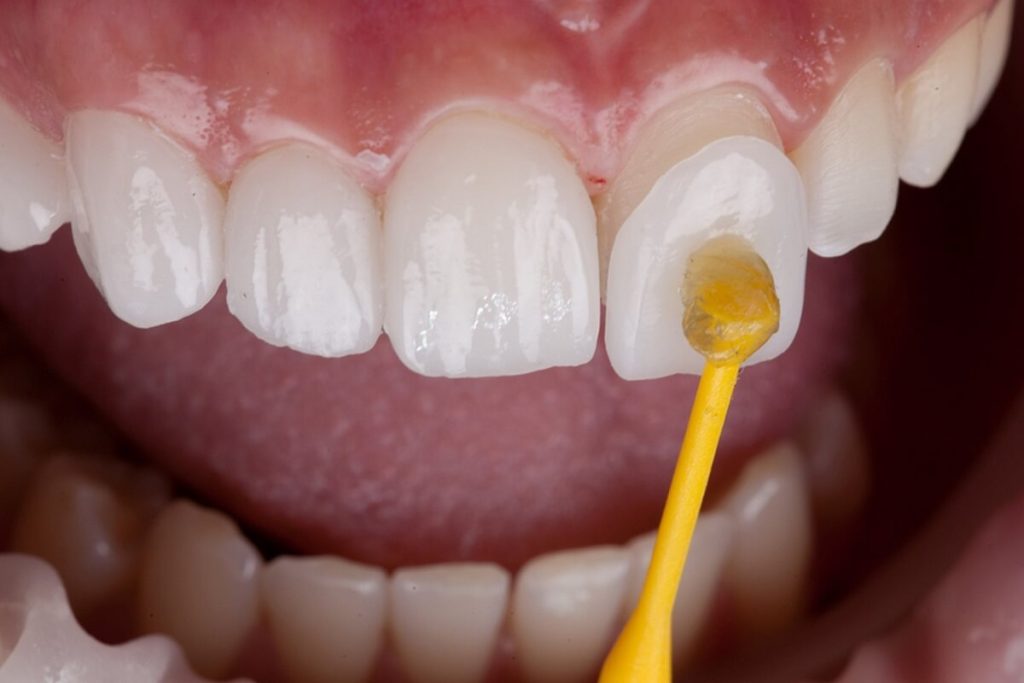 applying veneers to the teeth