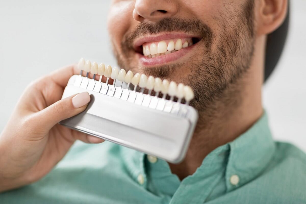 How Long Do Veneers Last? Top Tips for These Pearly Whites