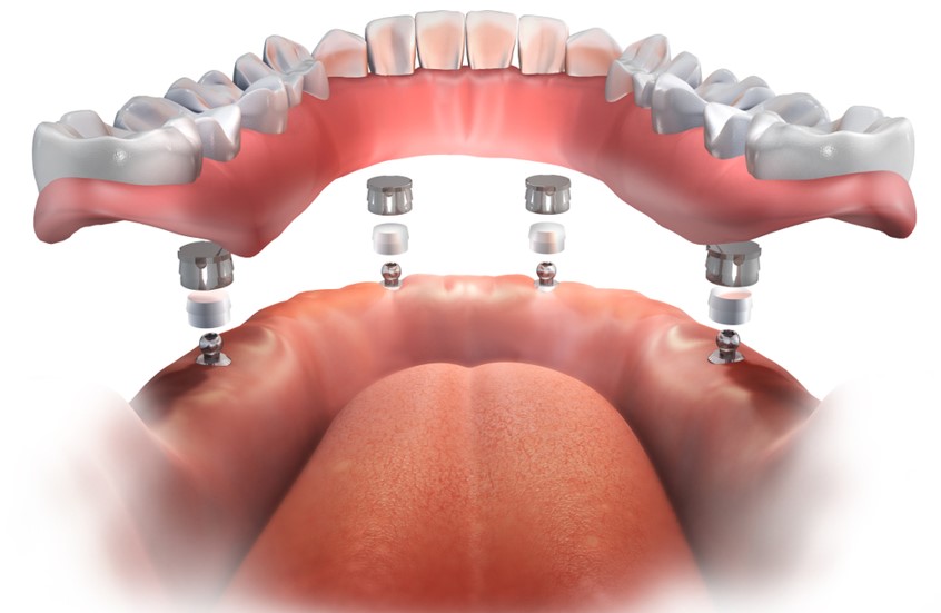 lower implant supported complete denture