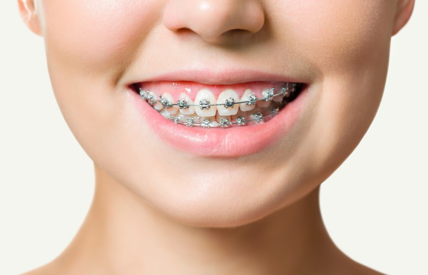 orthodontic treatment dental care