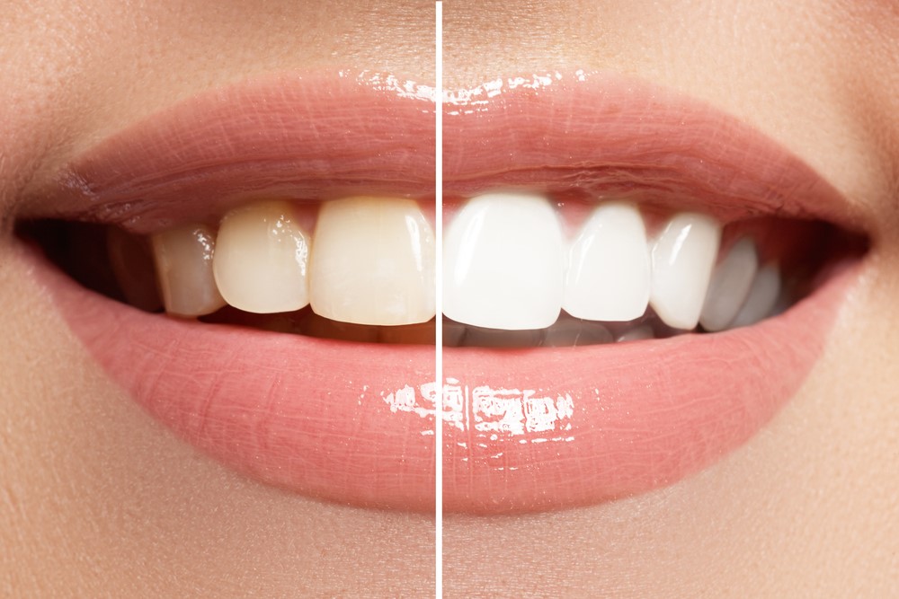 Before and after image of teeth whitening