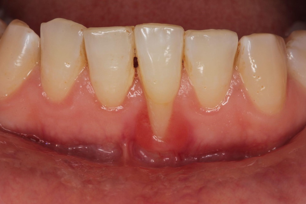 Gum recession on the lower teeth