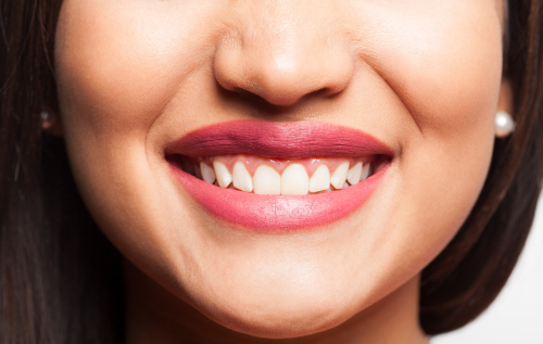 gum-contouring