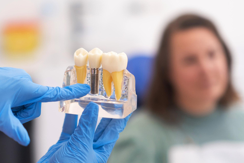 same-day-dental-implants-clinic
