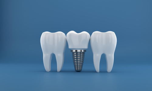 same-day-dental-implants-safety-and-effectiveness